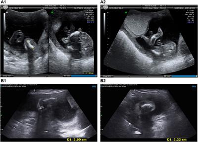 A Founder Pathogenic Variant of PPIB Unique to Chinese Population Causes Osteogenesis Imperfecta IX